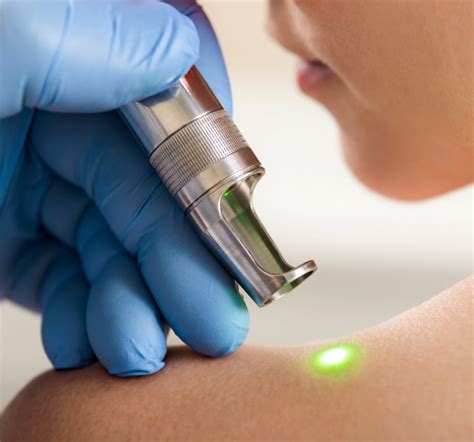 best affordable dermatology bay area laser lesion removal